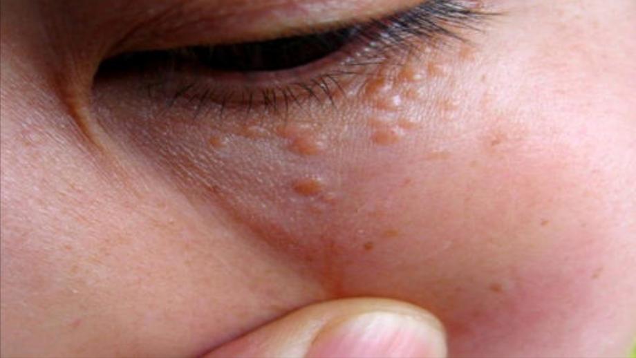 鼻子上挤出来的白色丝状物，看起来像一条虫子，是螨虫吗？