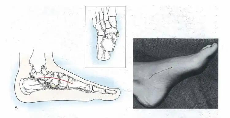 脚上多长了块骨头,腿关节多长了一块骨头