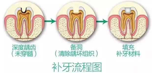 补牙医生故意把洞磨得更大,为什么医生给我补牙补得很随便