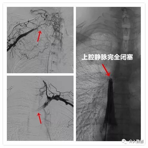 上腔静脉阻塞可以搭支架吗,上腔静脉支架植入大概多少钱