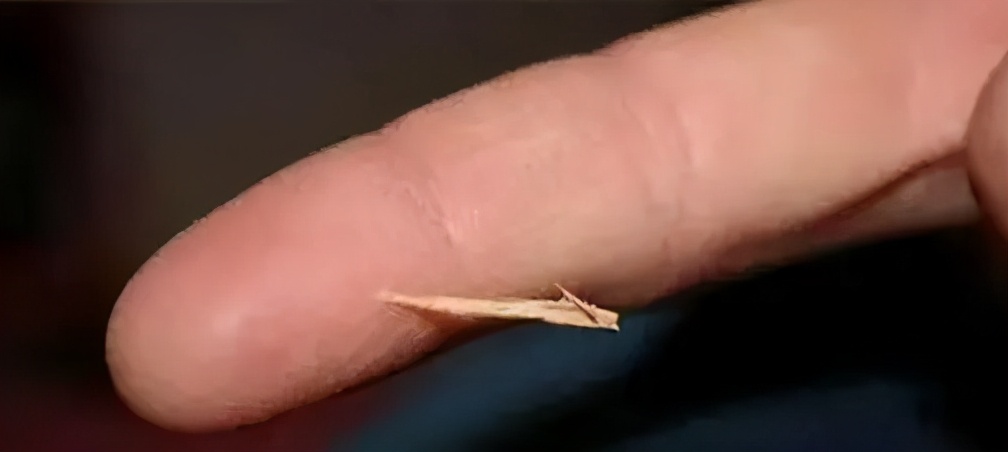 手机膜扎到肉里长好了怎么办,手机膜扎到手指里怎么办