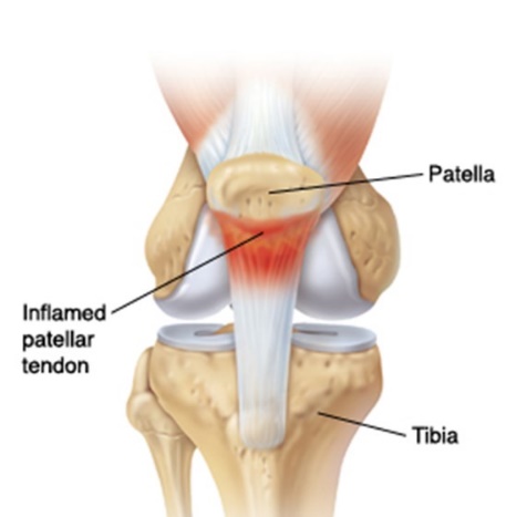 跑跳时膝盖突然疼一下,跑跳后膝盖弯曲疼痛怎么回事