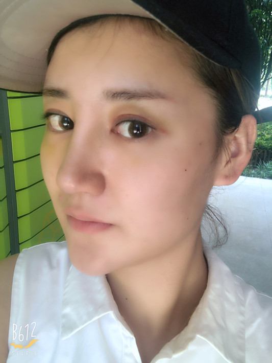隆鼻之后不好看怎么办,隆鼻后发现很假怎么办