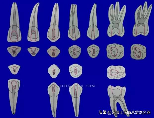 根管治疗难点与解决方案,根管治疗牢固吗