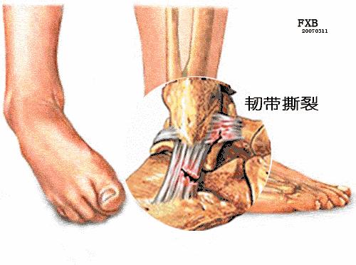 跑步后腿疼治疗办法有哪些,跑步腿疼脚疼怎么回事