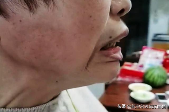 陈国强：令人烦恼的“咬牙切齿”竟是罕见的咬肌痉挛