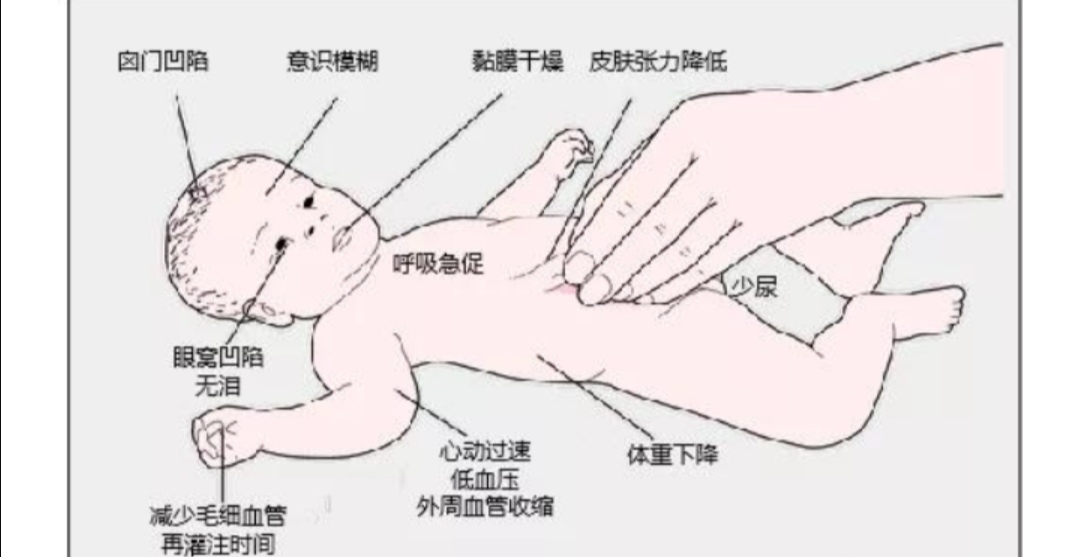 轮状病毒腹泻先呕吐还是先腹泻,轮状病毒孩子呕吐严重怎么处理