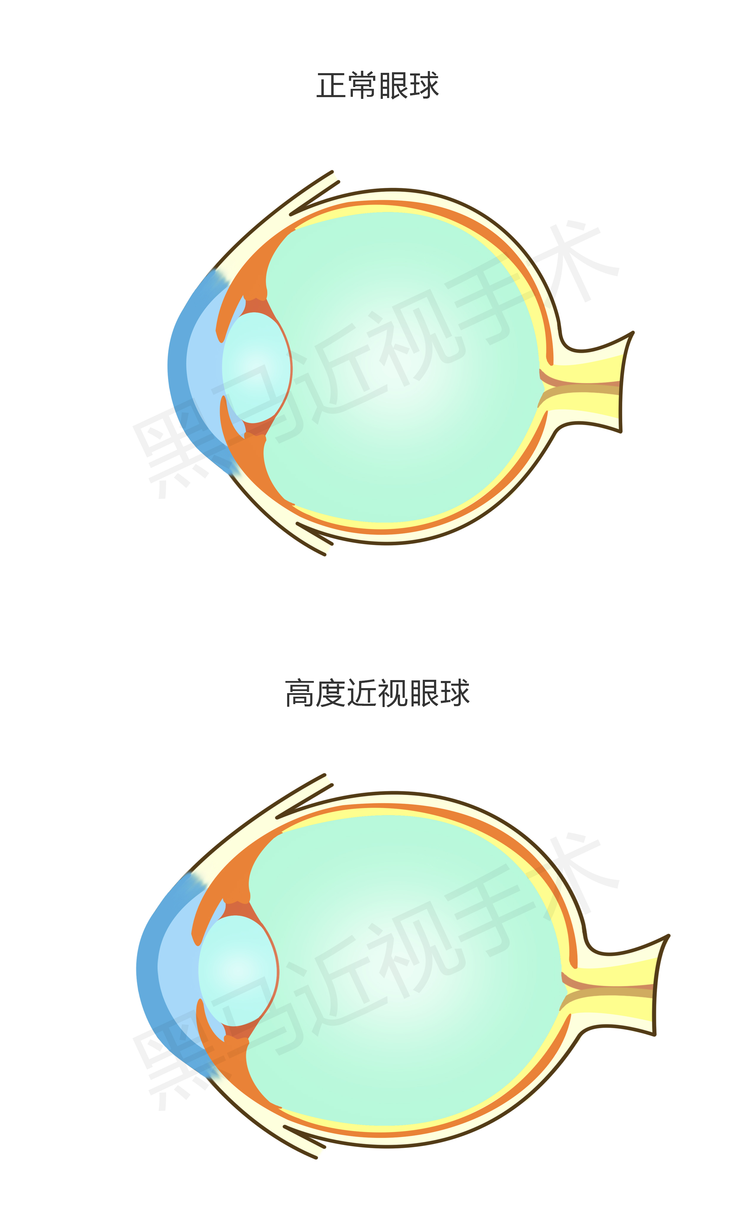 高度近视眼1000度视频,高度近视1000度会瞎吗