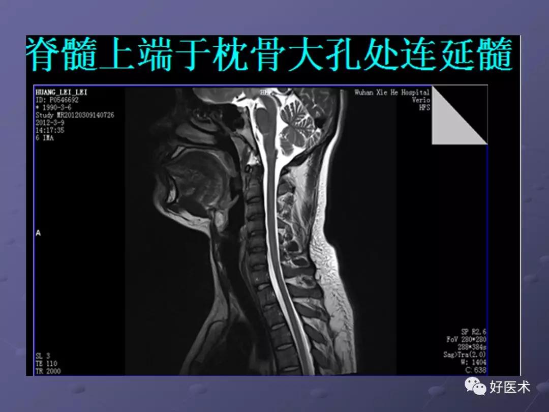 脊柱mri有哪些特点,乳腺疾病的mri诊断及鉴别