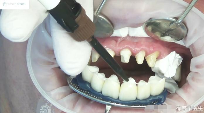 烤瓷牙贴片全口价格,贴片牙齿和烤瓷牙有哪些伤害