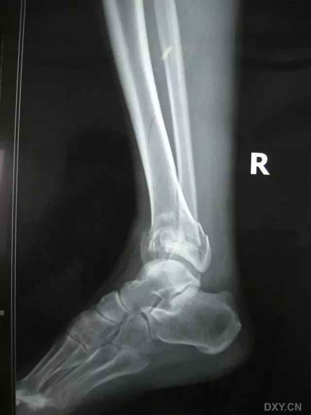 几种严重骨折医学名称,常见的骨折有哪些名称