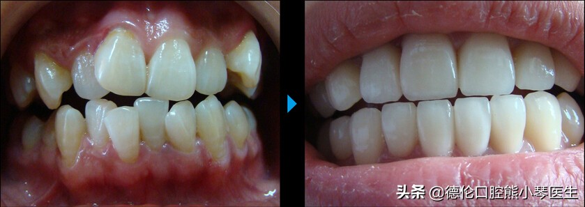 牙齿拥挤矫正3d视频,牙齿拥挤矫正一般多少钱