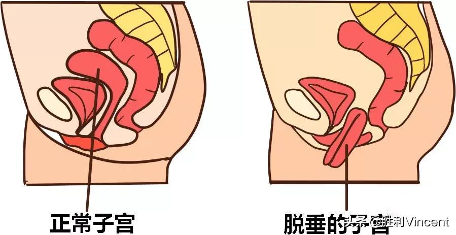 盆底肌腹直肌和骨盆修复哪个重要,了解盆底