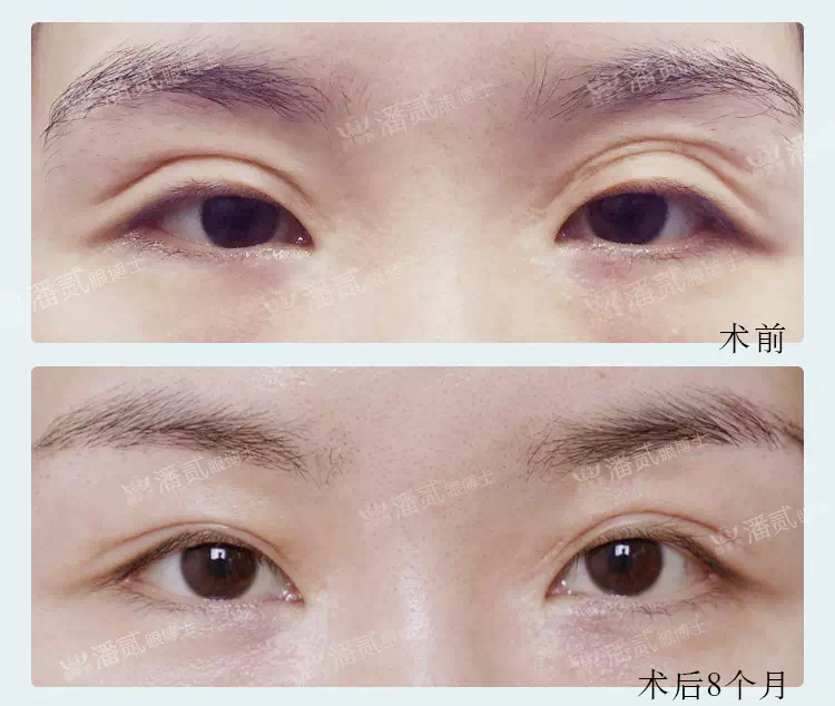 双眼皮失败的女孩,双眼皮失败做成了三眼皮好修复吗