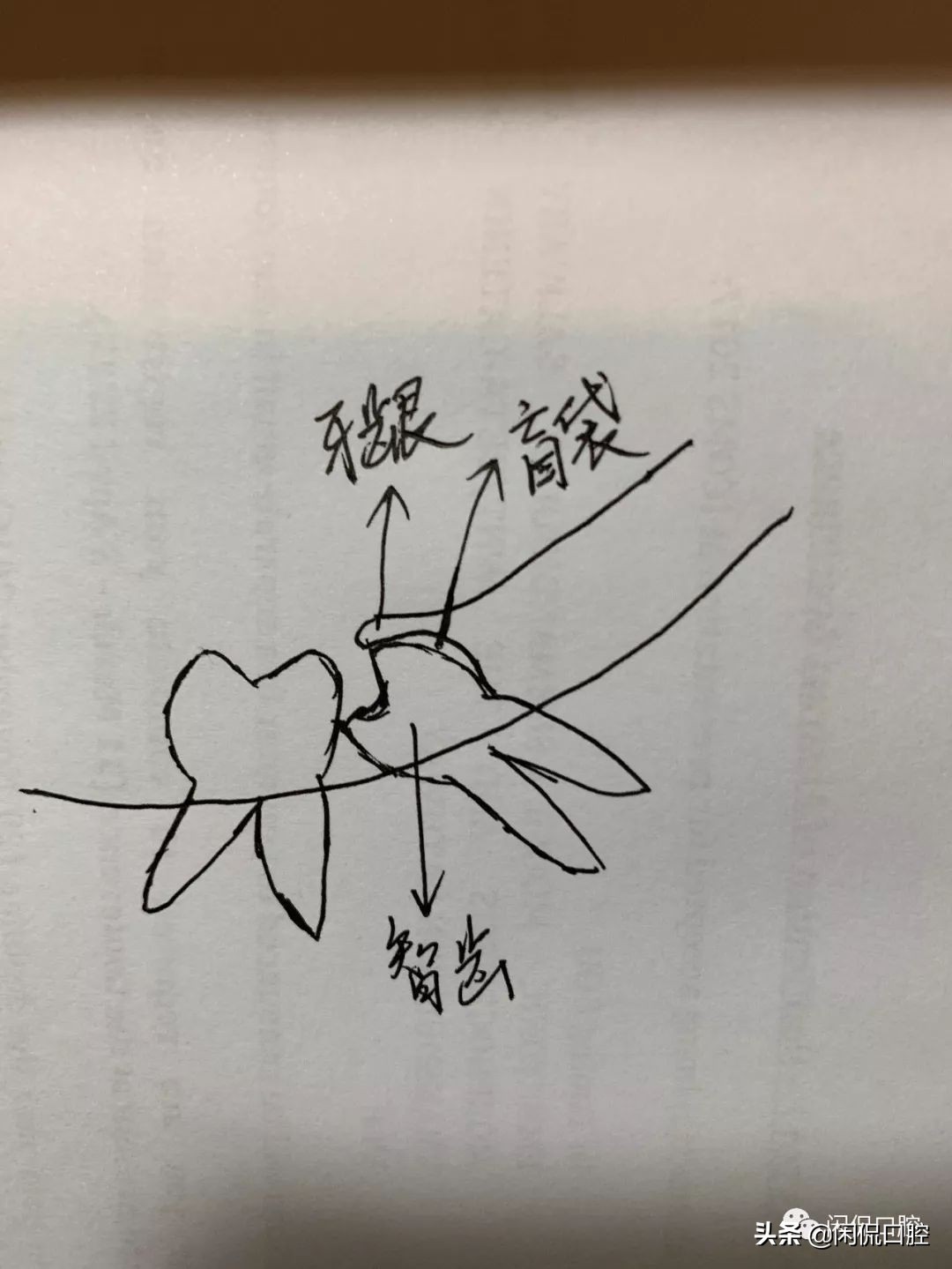 智齿长出一半被肉包着怎么办,智齿发炎怎么办最快最有效的方法