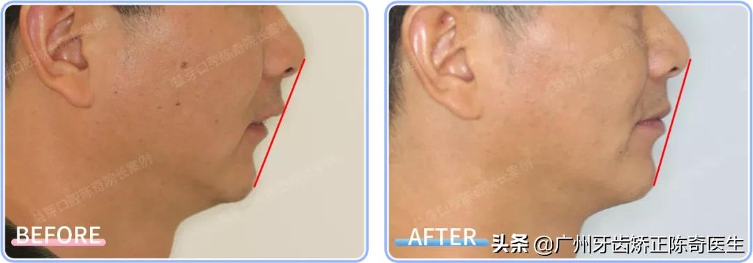 戴牙套会有下颌线,戴牙套的时候人会变丑吗