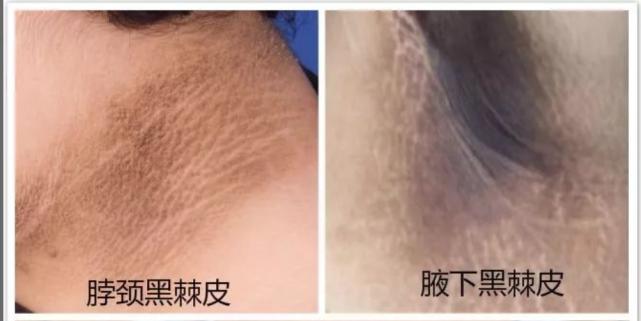 脖子旁边黑黑的洗不干净,为什么脖子上黑黑的洗不干净
