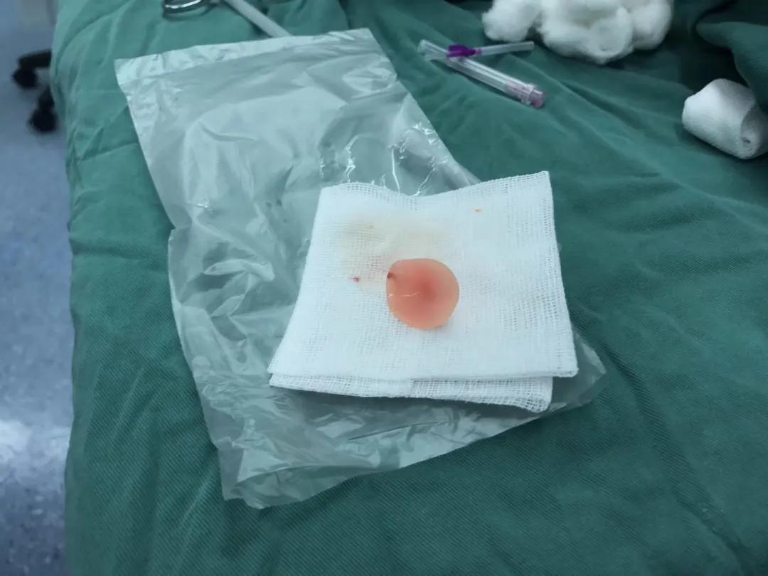 四岁孩子耳朵里塞进钢珠,小男孩往泥巴里塞6个钢珠