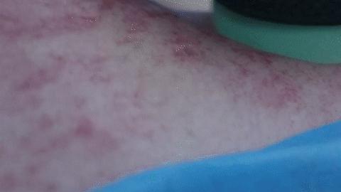 祛风散寒刮痧方法,天气冷身体痒中医如何处理