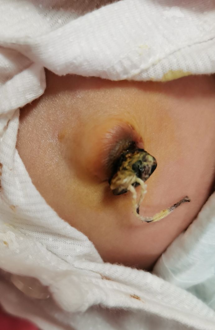 新生儿肚脐多久脱落21天,婴儿肚脐脱落后湿的怎么护理