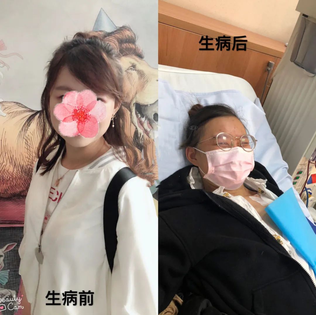 一年血肌酐从120提升到140,两年肌酐从80涨到160