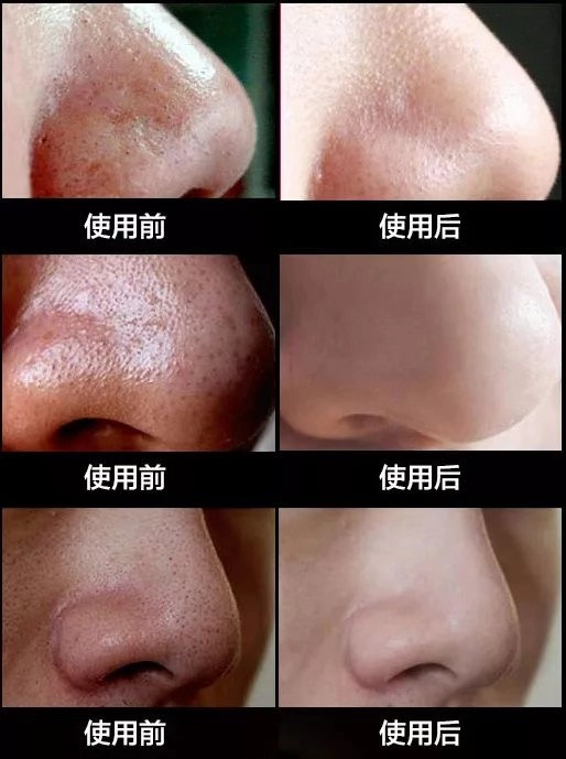 一秒去黑头去粉刺,一步就能搞定的黑头