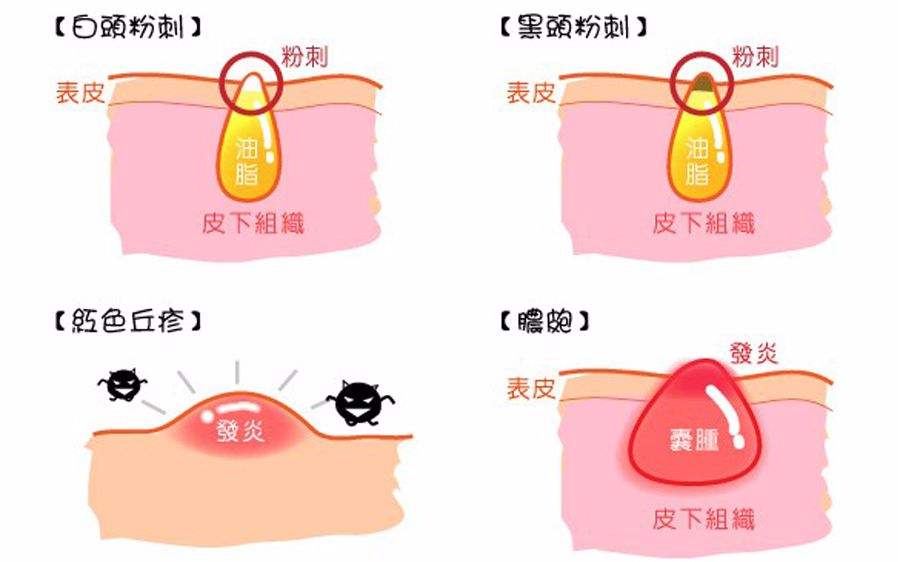 鼻子黑头多应该用什么护肤品,去毛孔黑头的护肤品