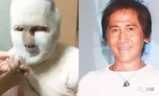 邓莎被烧伤原因,邓莎拔火罐被烧伤视频