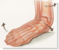 治疗扁平足,女生扁平足