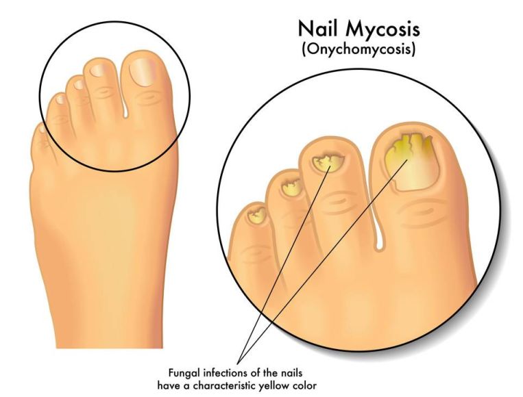 脚趾甲往肉里长怎么办很疼,脚趾甲长灰趾甲是什么情况