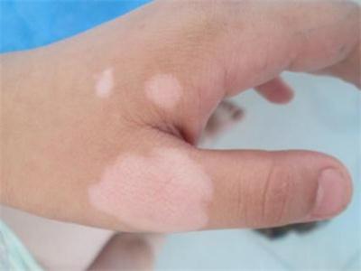 白斑和白癜风区别症状,白斑和白癜风有什么区别