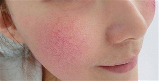 治疗激素脸敏感肌肤,激素脸屏障修护分享