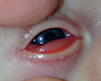 宝宝红眼病好的征兆,新生宝宝眼睛有点黄是怎么回事