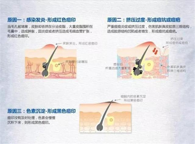 痘印严重到底怎么办,毁容式痘痘有什么办法消除