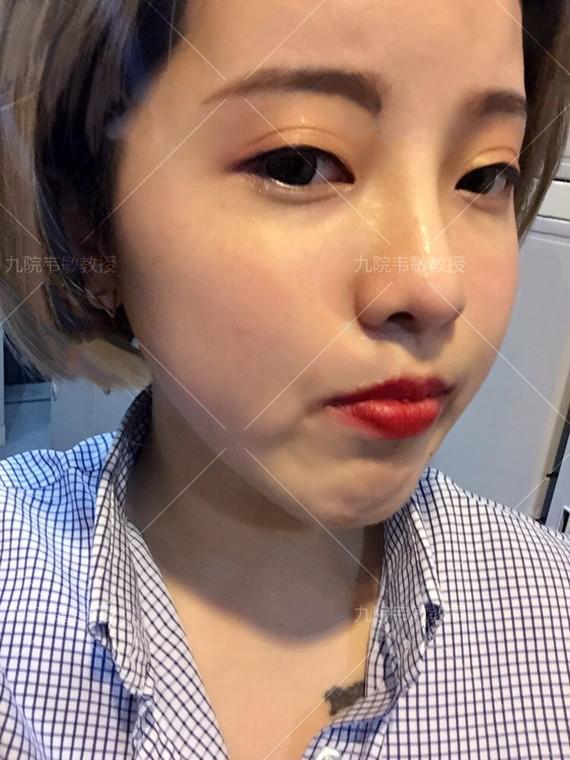 假体隆鼻科普之膨体隆鼻,膨体隆鼻整形效果怎么样