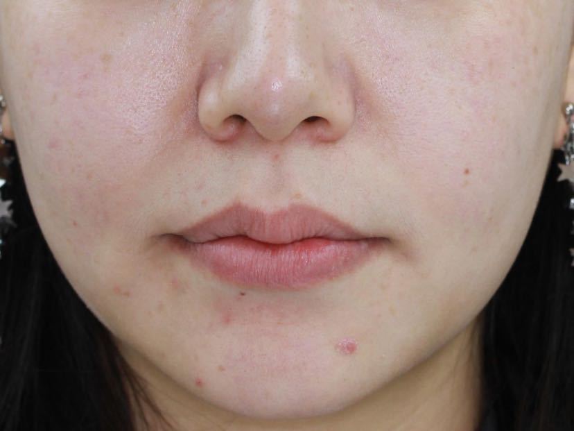 西安张军正畸医生如何,西安牙齿矫正案例