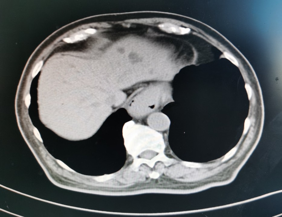 贲门癌吐血抢救,中国最著名的贲门癌治疗专家