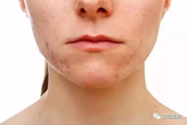 热姜水和生姜水的作用及功效,热生姜的功效和作用