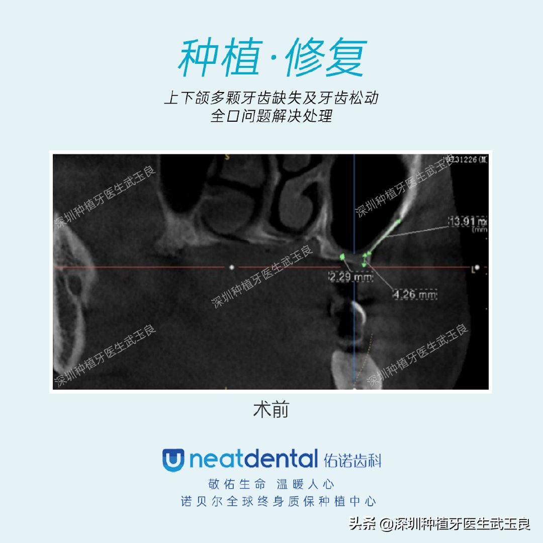 多颗牙齿缺失怎么修复全过程,多颗缺失牙修复案例