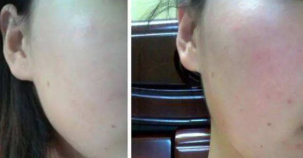 敏感肌脸部泛红刺痛如何快速缓解,敏感肌脸泛红过敏怎么处理