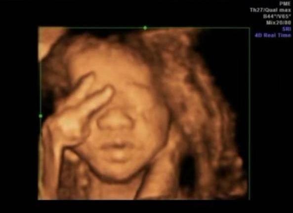 澶╂墠鑳庡効瀹岀粨,澶╂墠鑳庡効