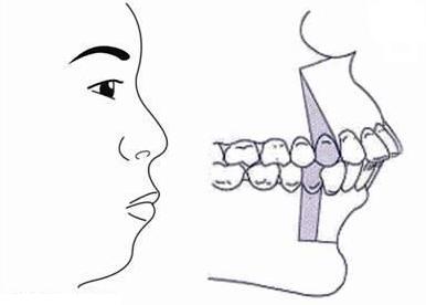 严重的龅牙可以磨掉吗,严重龅牙可以矫正吗