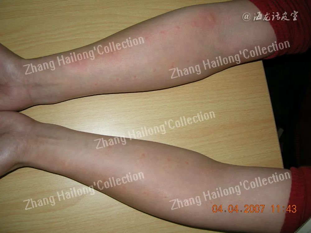 皮肤老是过敏荨麻疹怎么回事,过敏引起的荨麻疹怎么治才会好