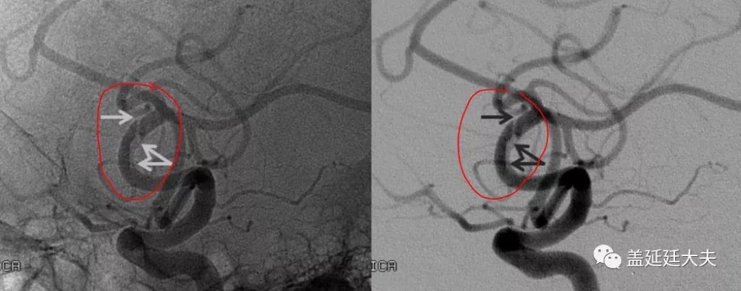 DR盖延廷||颈动脉夹层该如何治疗