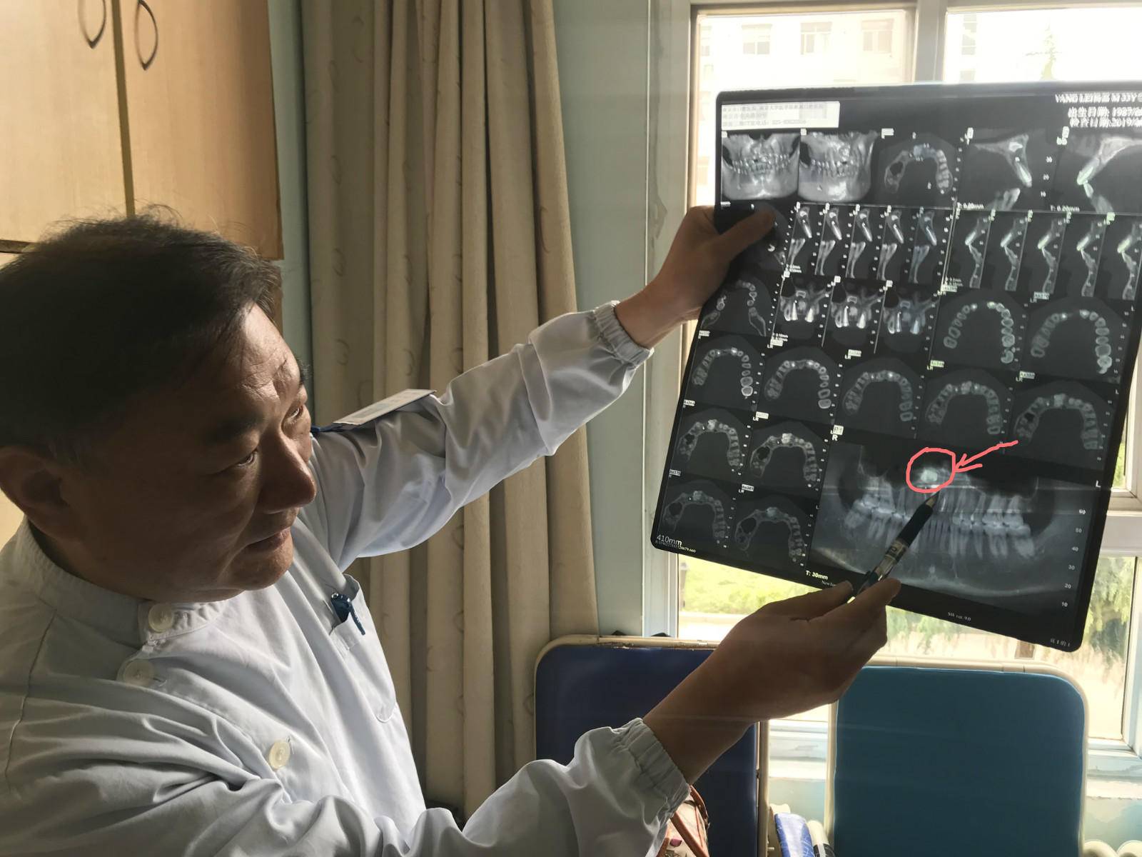 奇事！门牙一直没长出来，竟是长到鼻腔了