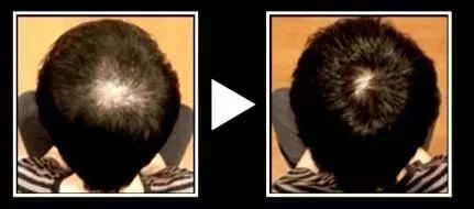 “十男八秃”的日本男人疯抢这瓶小黑钻!让头发不再掉了