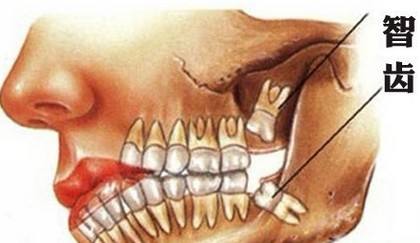 全麻拔四颗智齿真实经历,拔四个智齿后的恢复过程