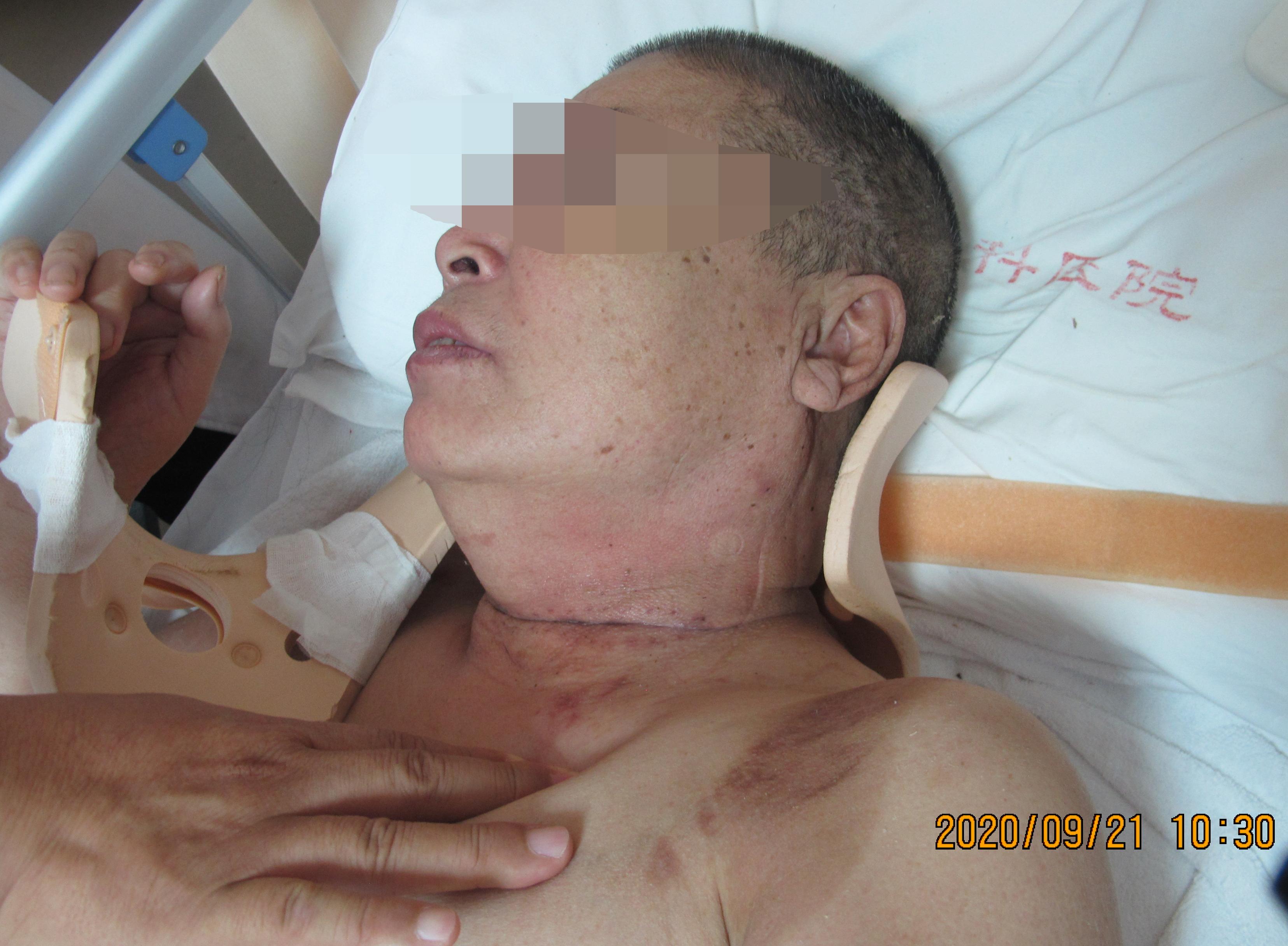 颈椎术后脑脊液漏取什么体位,脊髓型颈椎病手术后植骨愈合时间