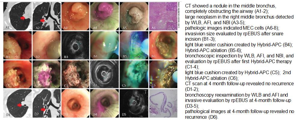 全球对肺癌治疗的最有效最新技术,肺癌的支气管镜介入治疗