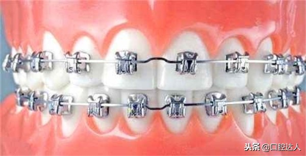 牙齿矫正完以后会反弹吗,牙齿矫正后会反弹吗知乎